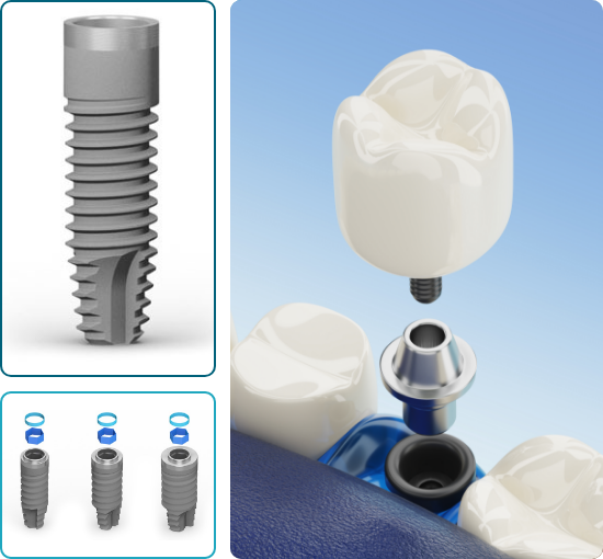 Implantologia Dentale Torino