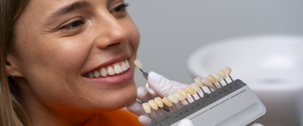 faccette dentali cosa sono