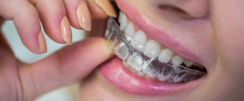 apparecchio denti invisibile costi e fattori