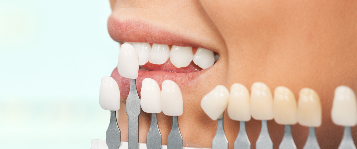 faccette dentali torino