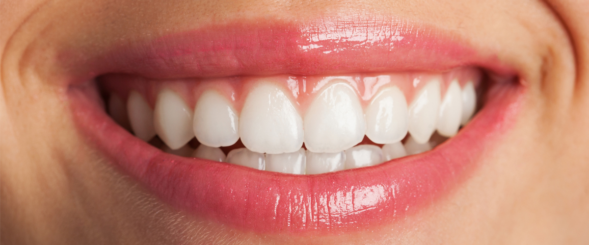 quanto costano le faccette dentali