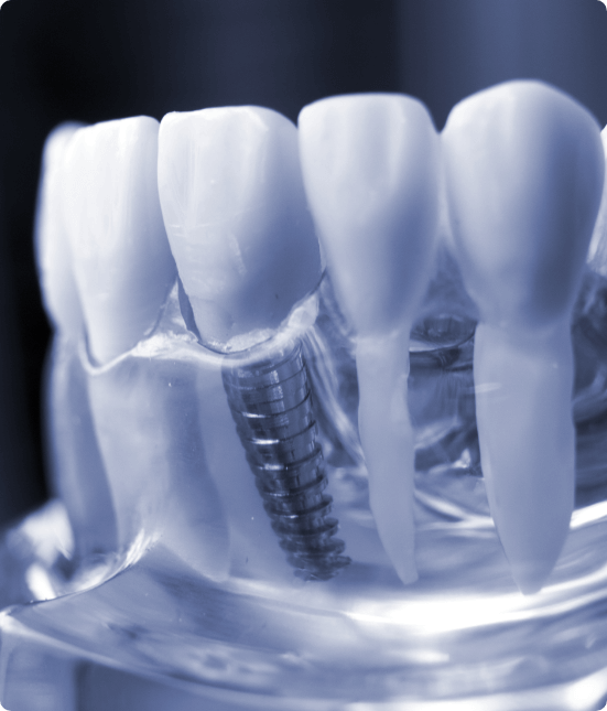 impianti dentali Torino